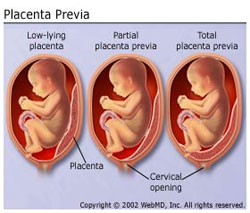 placenta_pravia