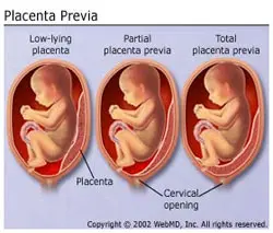 placenta_pravia placenta_pravia