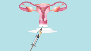 Exploring IUI_ A Guide to Intrauterine Insemination