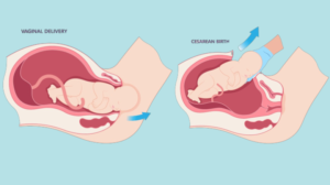 Natural Birth vs. C-Section_ Making Informed Delivery Choices